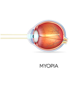 myopia