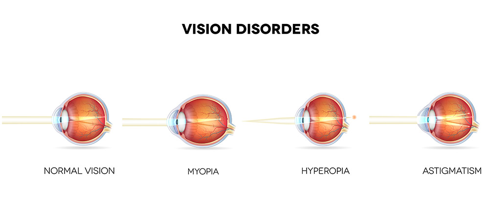 vision-disorders